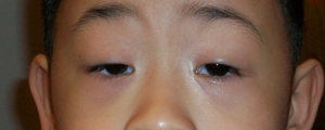 asian-blepharoplasty