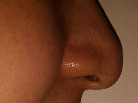 nasal flare