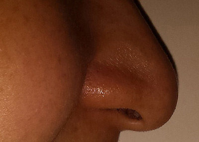 nasal flare