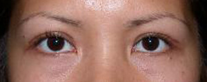 asian-blepharoplasty