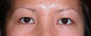 asian-blepharoplasty
