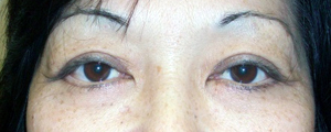 asian-blepharoplasty