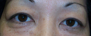asian-blepharoplasty