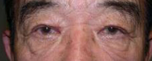 asian-blepharoplasty
