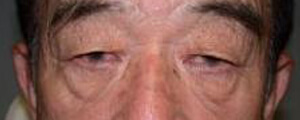 asian-blepharoplasty