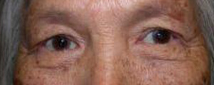 asian-blepharoplasty