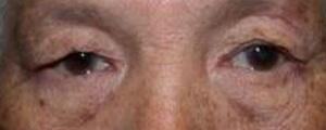 asian-blepharoplasty