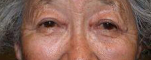 asian-blepharoplasty