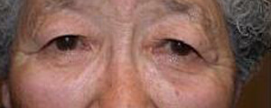 asian-blepharoplasty