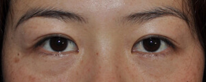 asian-blepharoplasty