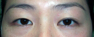 asian-blepharoplasty