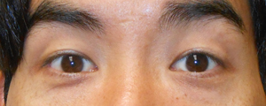 asian-blepharoplasty