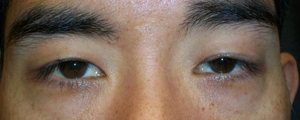 asian-blepharoplasty