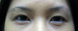 asian-blepharoplasty
