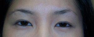 asian-blepharoplasty