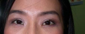 asian-blepharoplasty