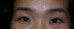 asian-blepharoplasty