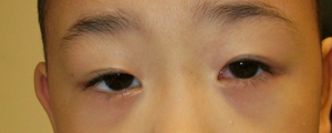 asian-blepharoplasty