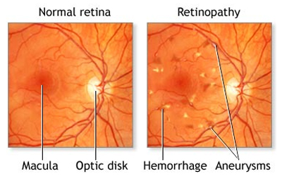 diabetic-retinopathy