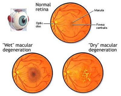 macular degeneration