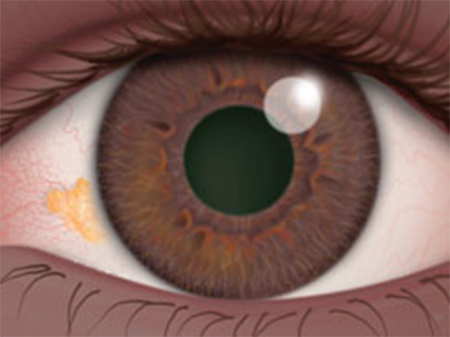 pterygium