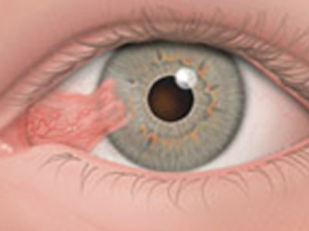 pterygium